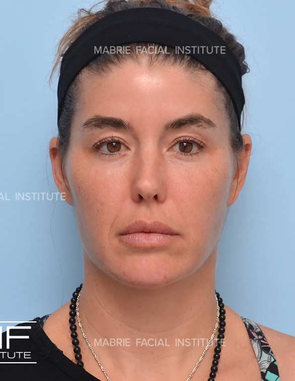 After complete facial rejuvenation