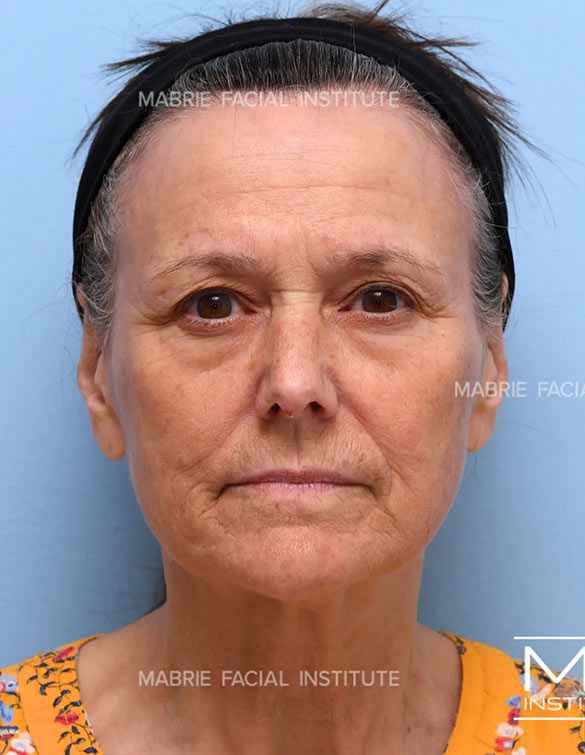 Before complete facial rejuvenation