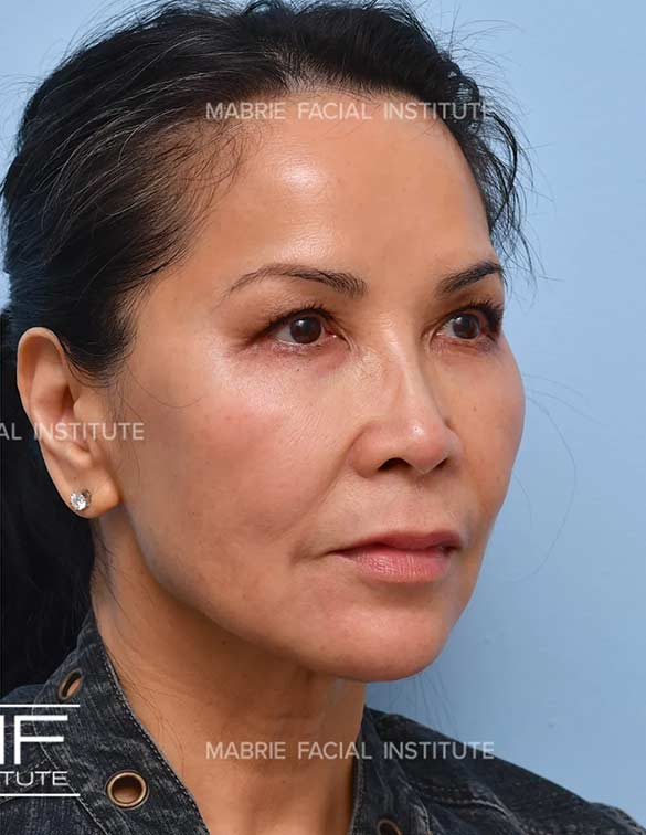 After complete facial rejuvenation