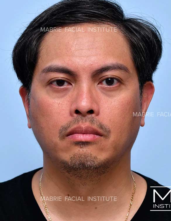 Before complete facial rejuvenation