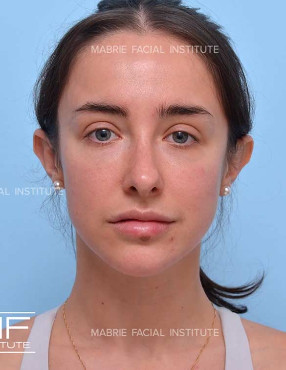 After complete facial rejuvenation