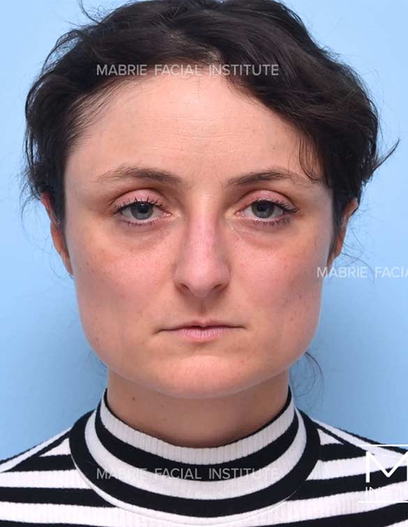 Before complete facial rejuvenation