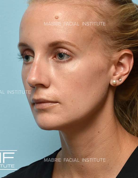 After complete facial rejuvenation