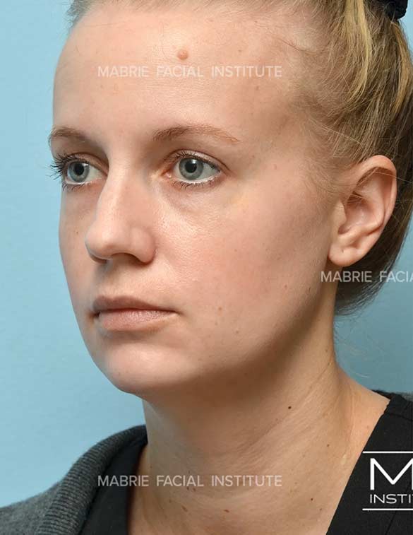 Before complete facial rejuvenation