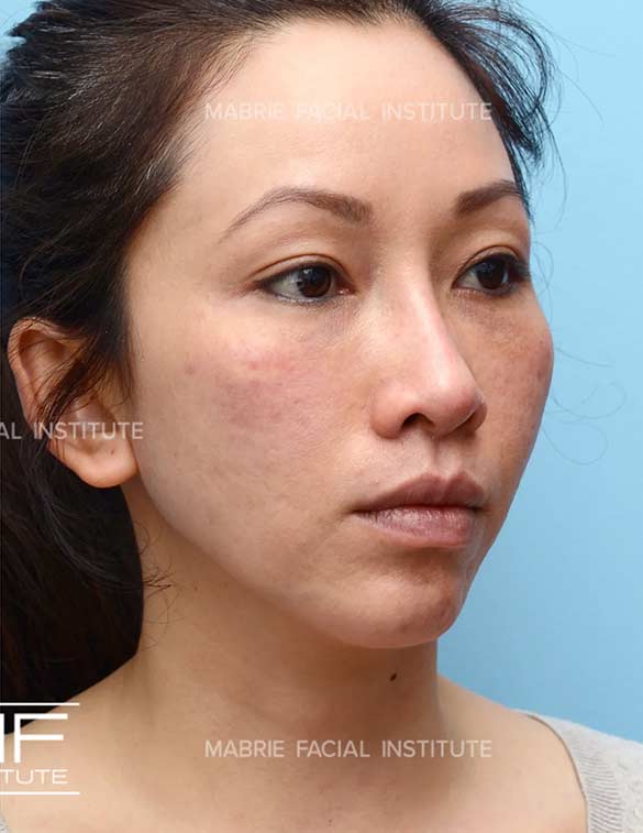 After complete facial rejuvenation