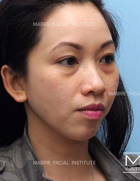 Before complete facial rejuvenation