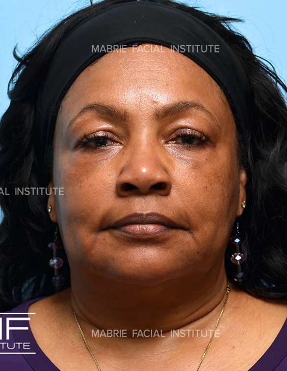 After complete facial rejuvenation