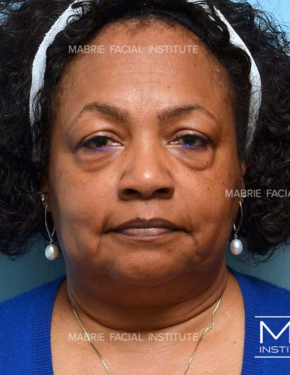 Before complete facial rejuvenation