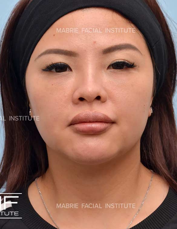 After complete facial rejuvenation