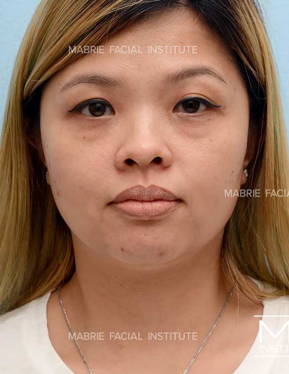 Before complete facial rejuvenation