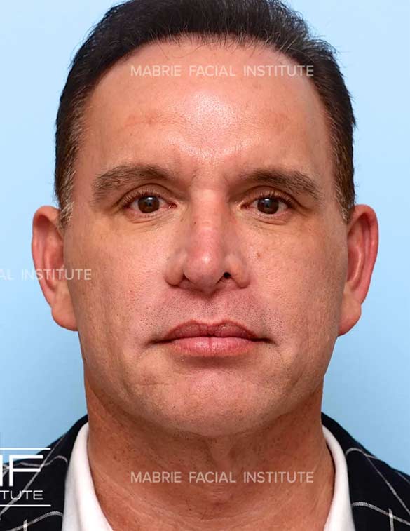 After complete facial rejuvenation