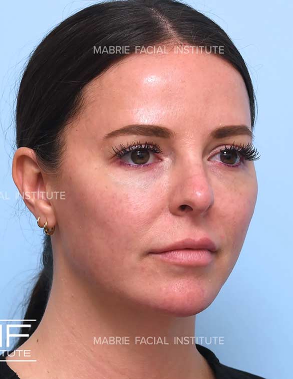 After complete facial rejuvenation