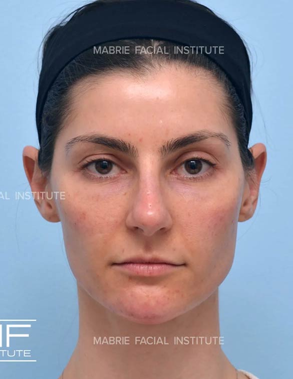 After complete facial rejuvenation