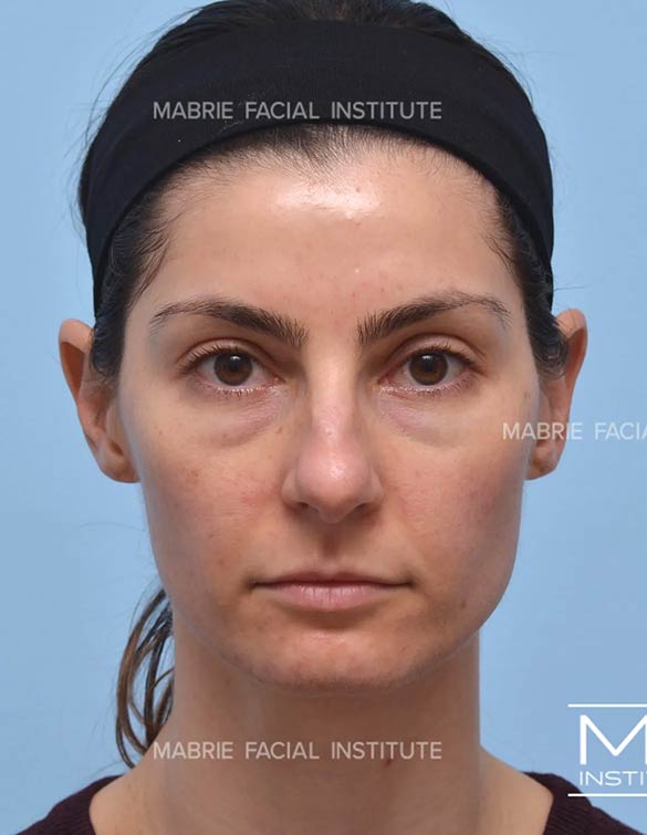 Before complete facial rejuvenation
