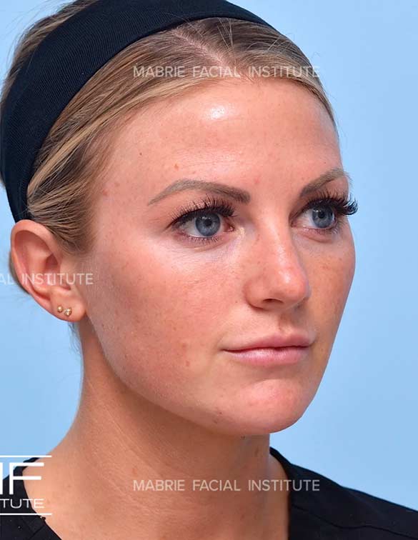 After complete facial rejuvenation