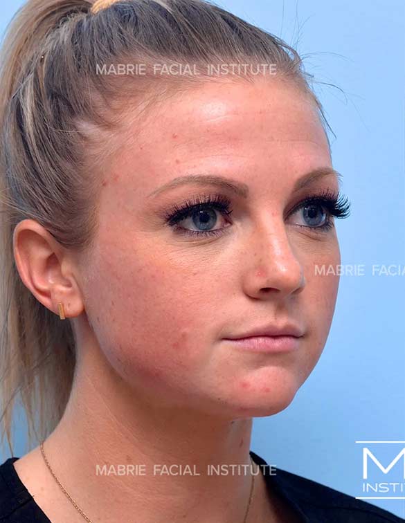 Before complete facial rejuvenation