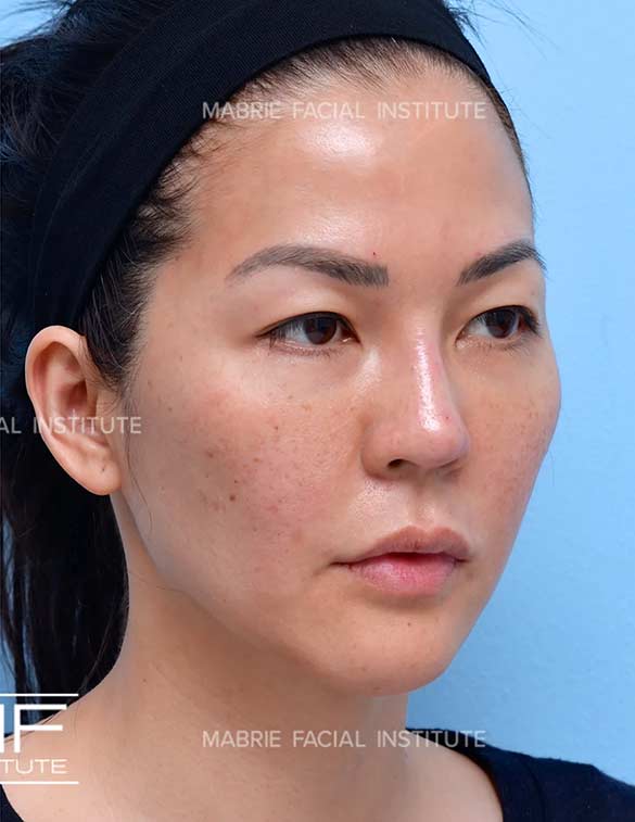 After complete facial rejuvenation