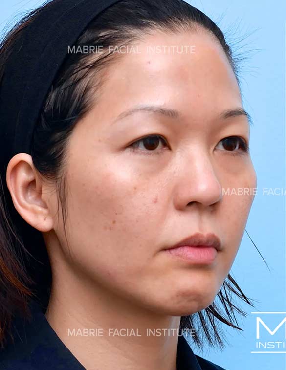 Before complete facial rejuvenation