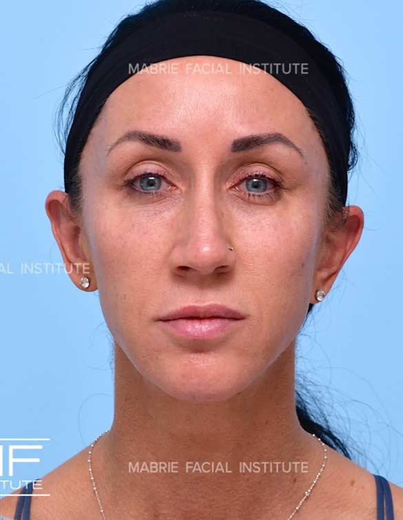 After complete facial rejuvenation