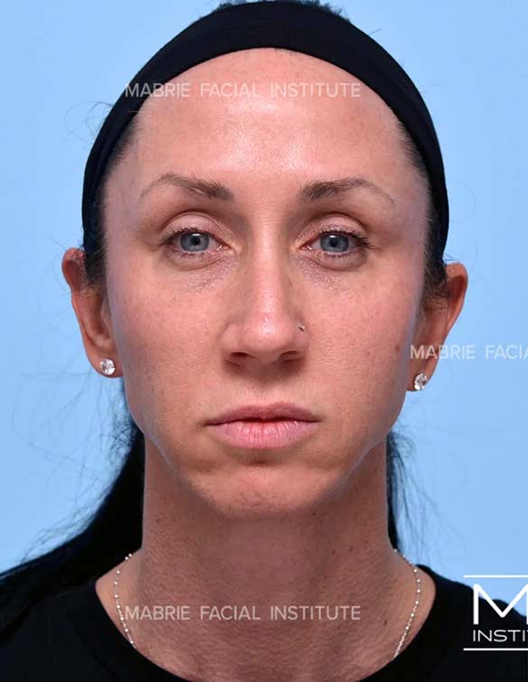 Before complete facial rejuvenation