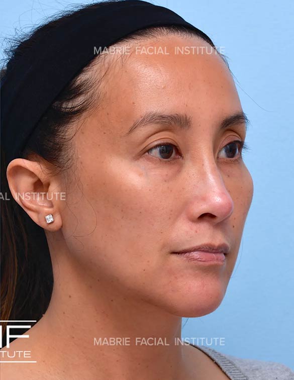 After complete facial rejuvenation