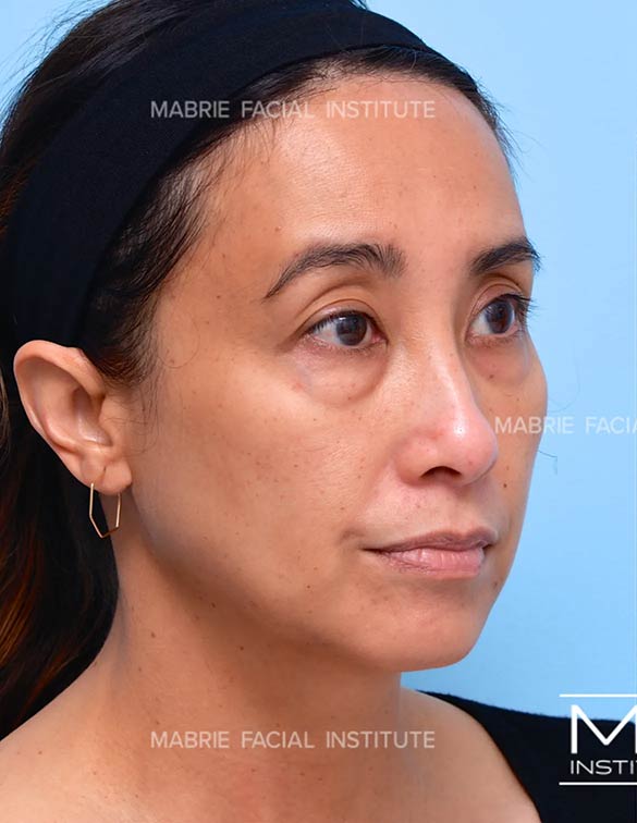 Before complete facial rejuvenation
