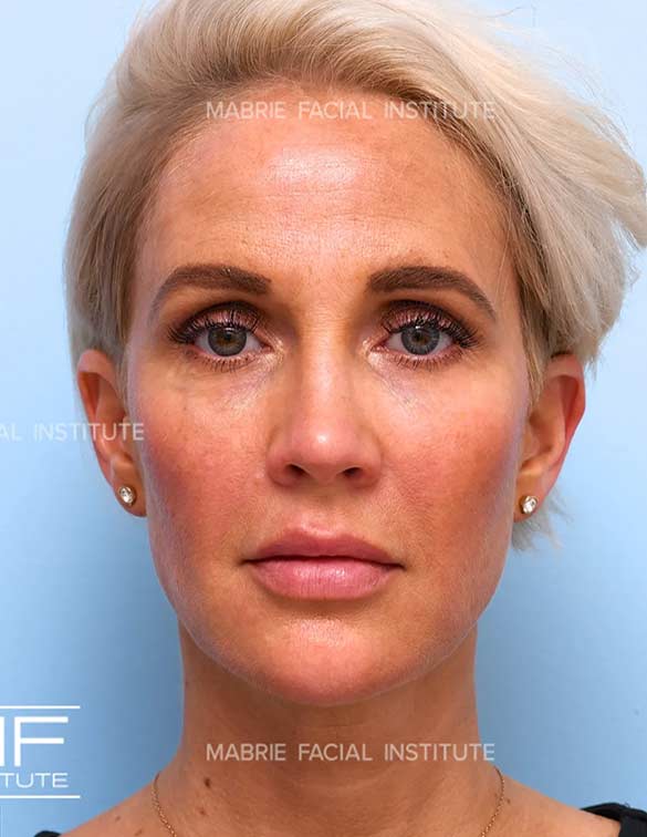 After complete facial rejuvenation