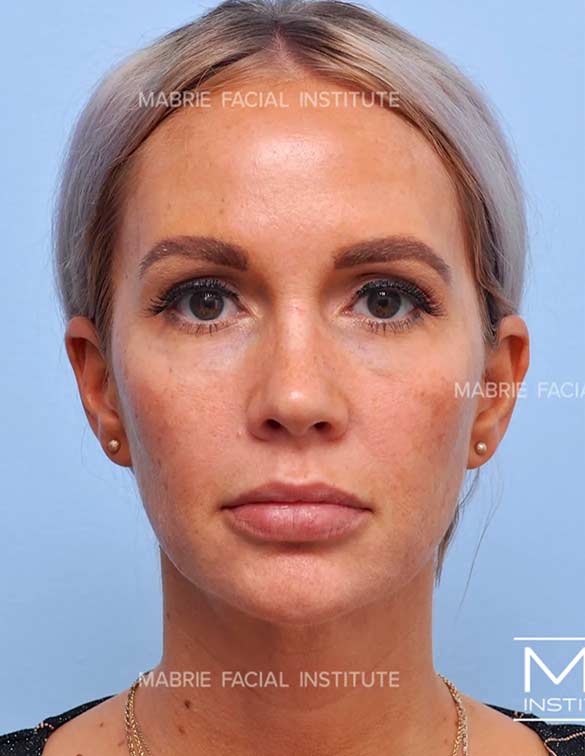 After complete facial rejuvenation