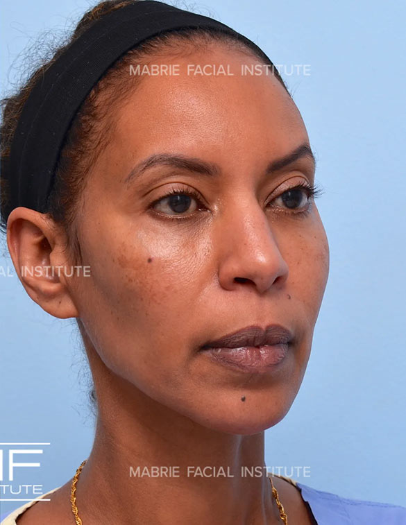 After complete facial rejuvenation