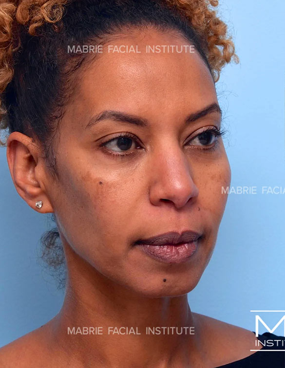 Before complete facial rejuvenation