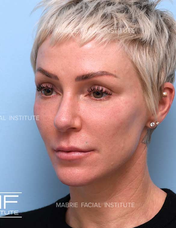 After complete facial rejuvenation