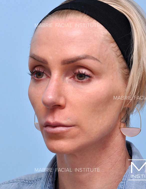 Before complete facial rejuvenation