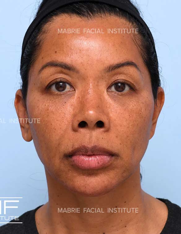 After complete facial rejuvenation