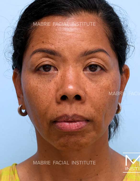 Before complete facial rejuvenation