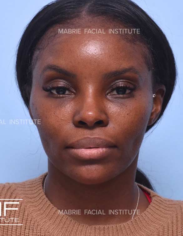 After complete facial rejuvenation
