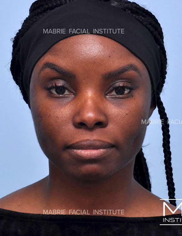 Before complete facial rejuvenation