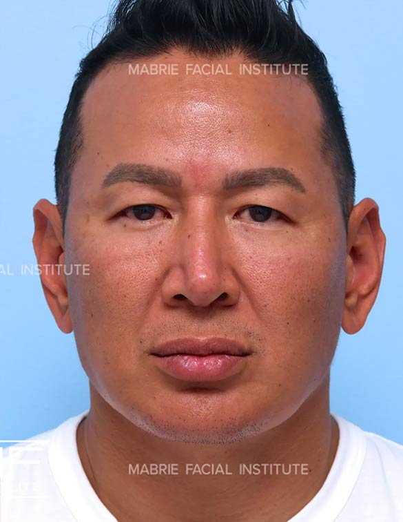 After complete facial rejuvenation