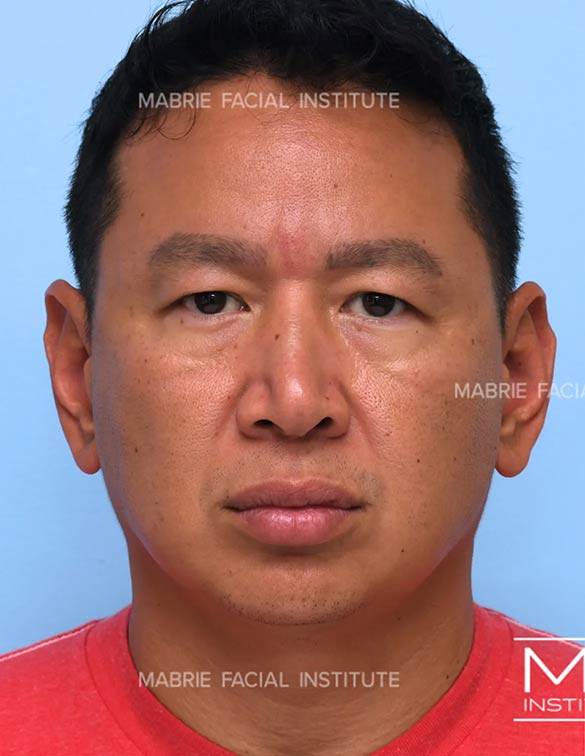 Before complete facial rejuvenation
