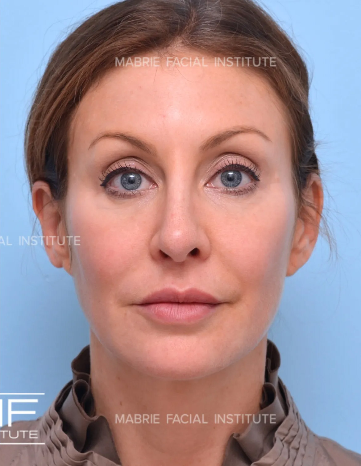 Woman after under eye filler treatment