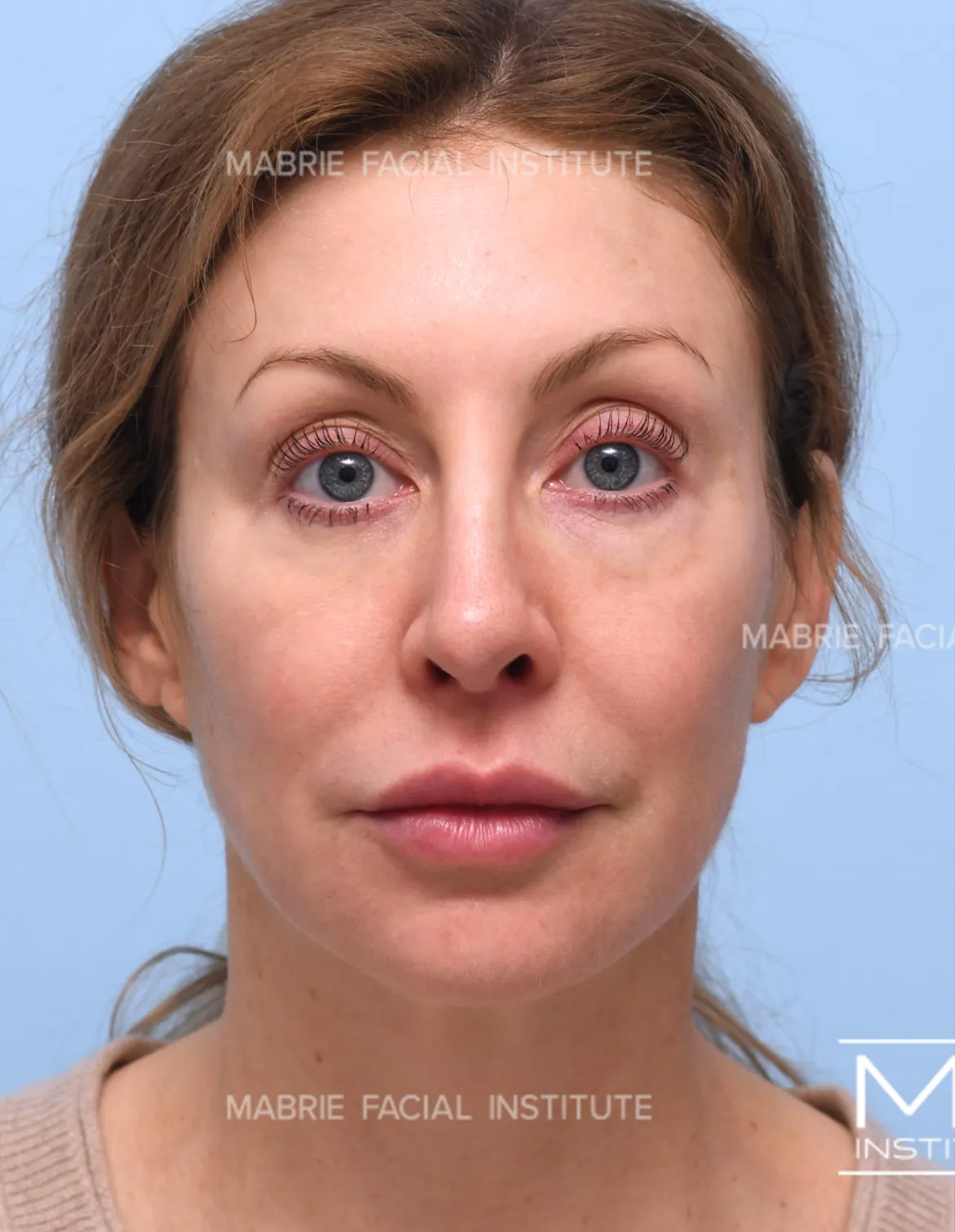 Woman before under eye filler treatment