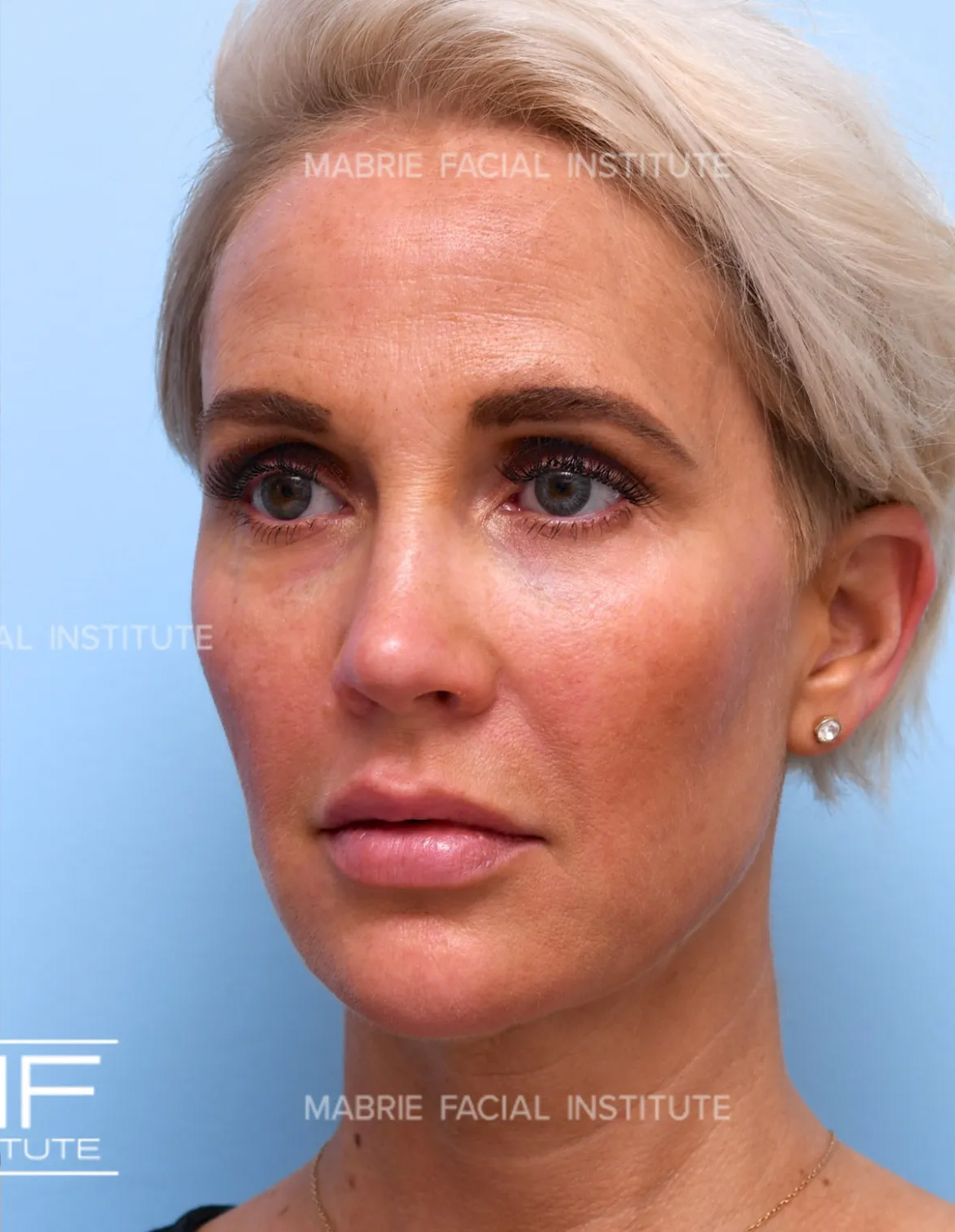 Woman after under eye filler treatment