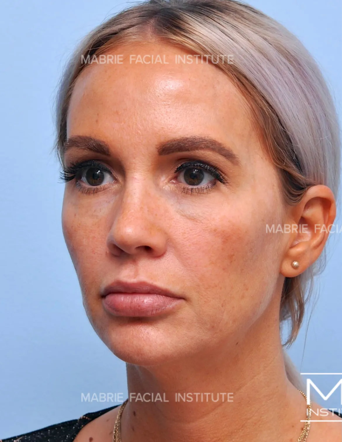 Woman before under eye filler treatment