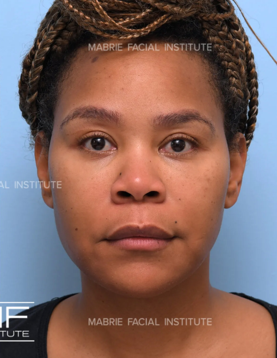 Woman after under eye filler treatment
