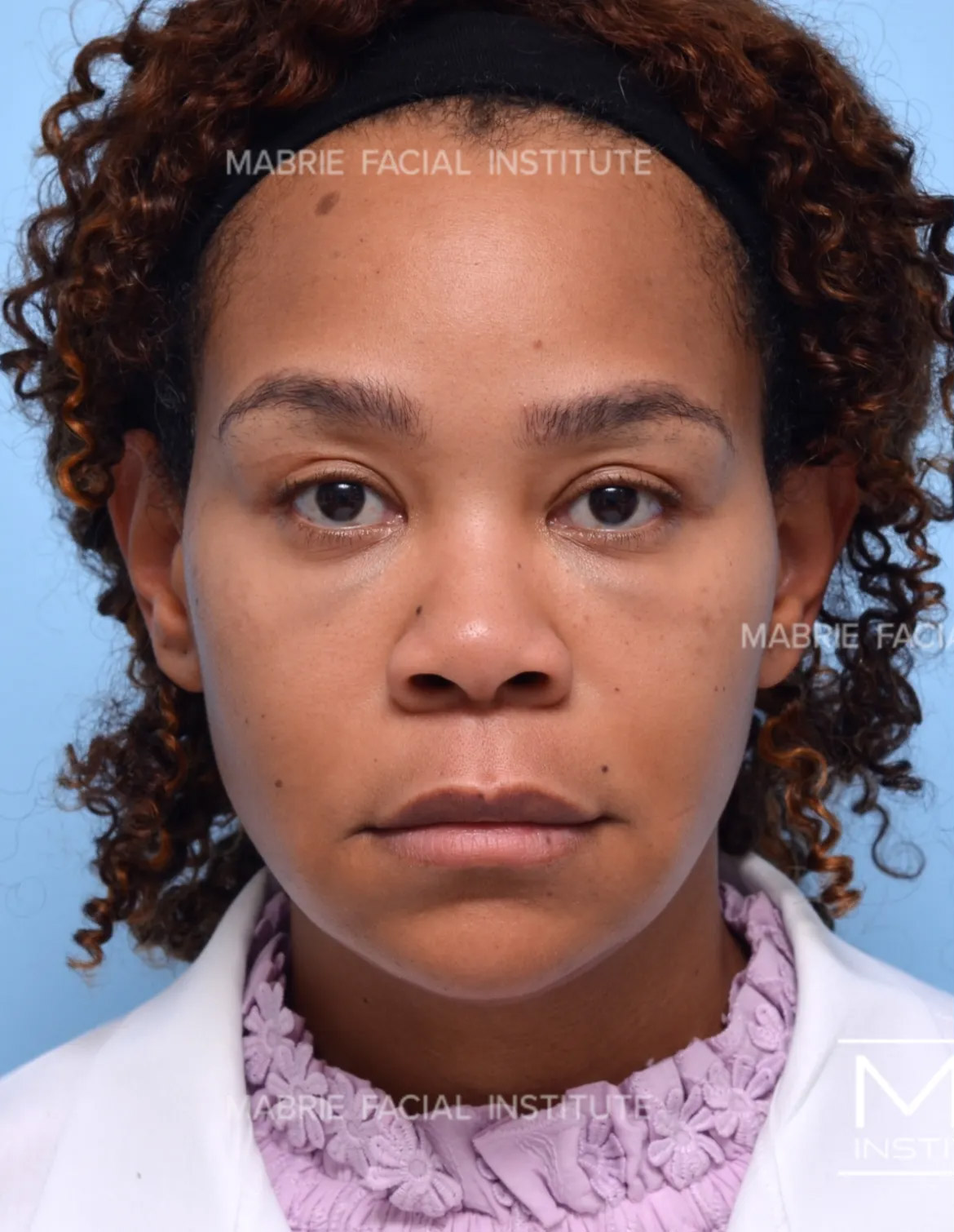 Woman before under eye filler treatment