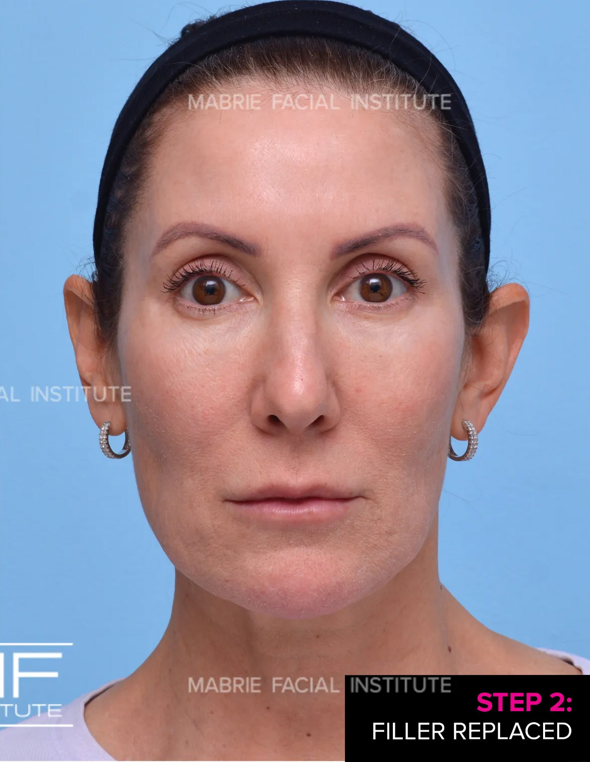 Woman after under eye filler treatment