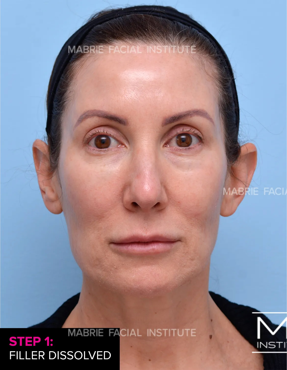 Woman before under eye filler treatment