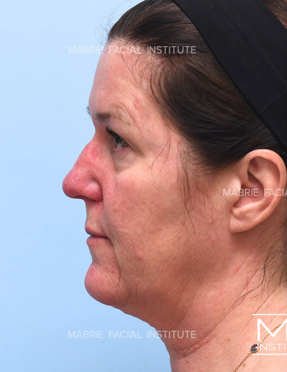 Illumination 360° Full Face before
