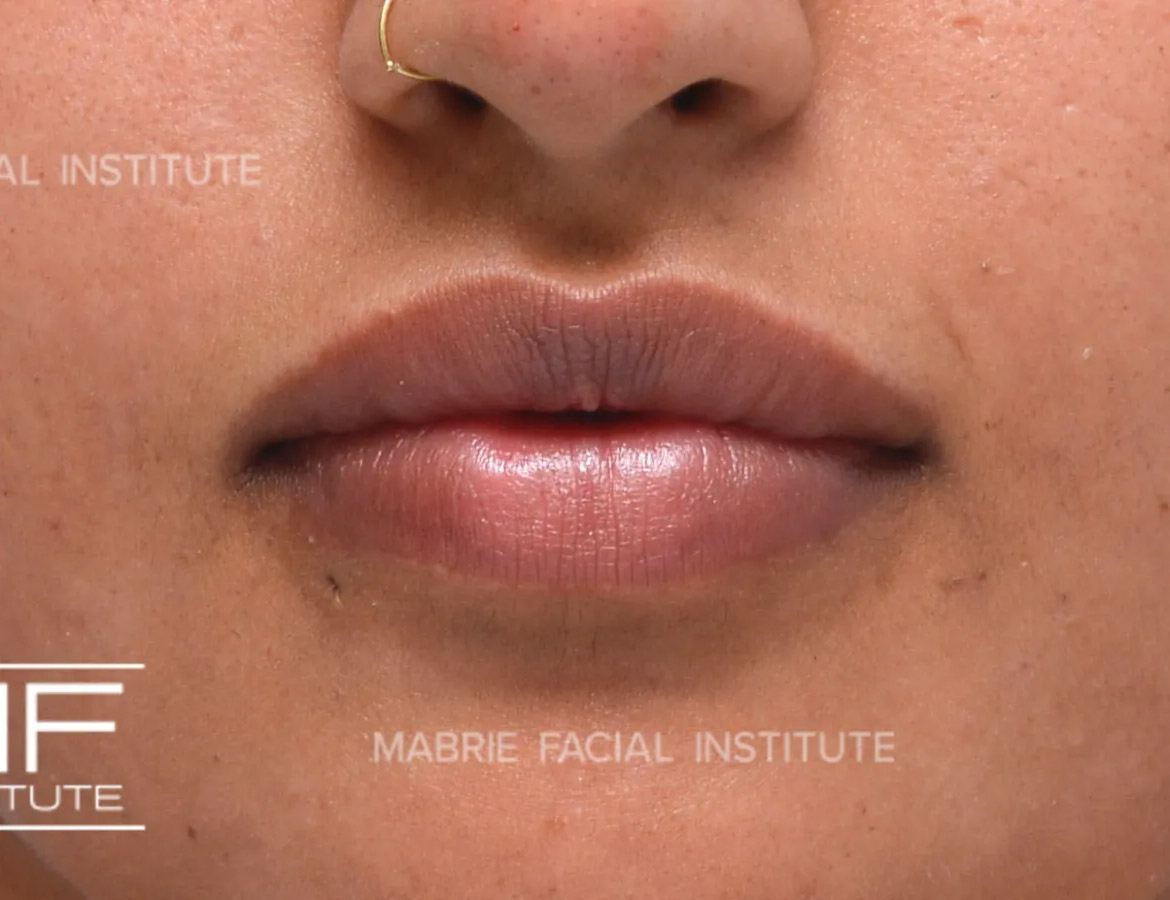 Woman after lip filler treatment