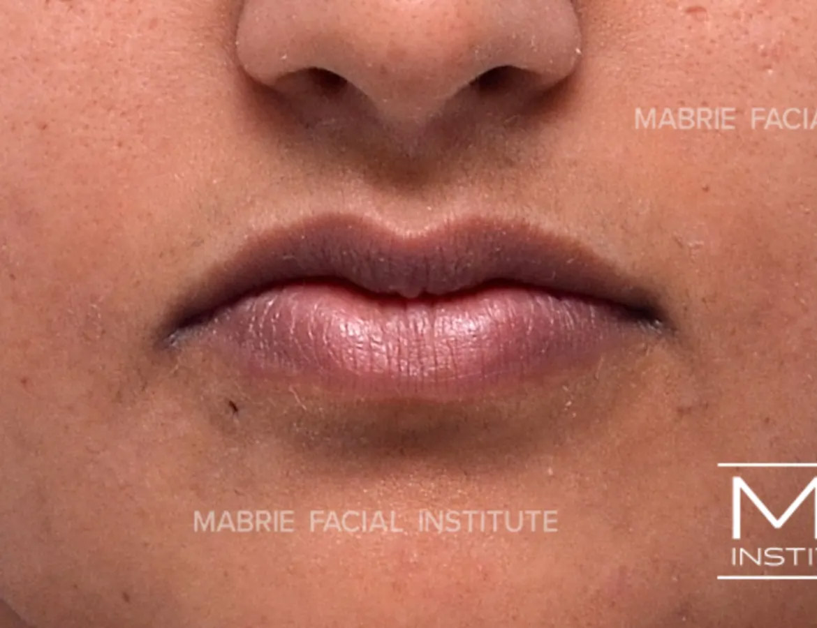 Woman before lip filler treatment