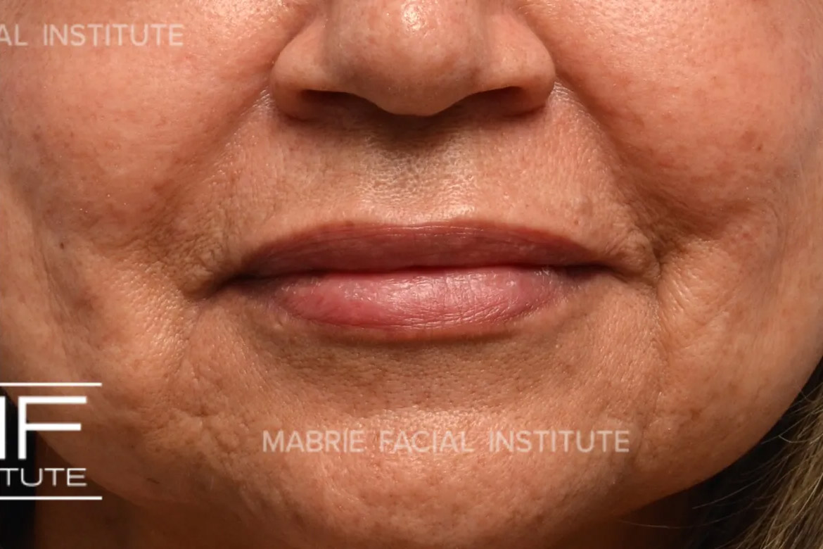 Woman after Subtle Lip Filler treatment